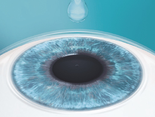 Schritt 1: ICL – Implantierbare Kontaktlinsen​ im Augenzentrum Oberstenfeld