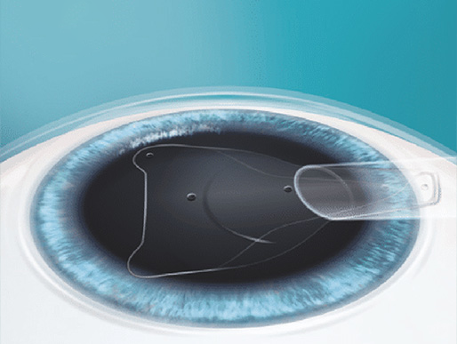 Schritt 2: ICL – Implantierbare Kontaktlinsen​ im Augenzentrum Oberstenfeld