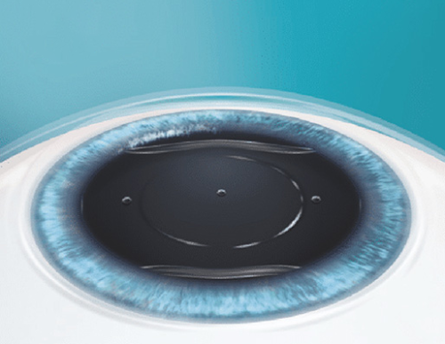 Schritt 3: ICL – Implantierbare Kontaktlinsen​ im Augenzentrum Oberstenfeld