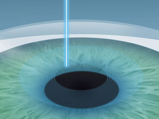Schritt 1: LASIK Augenlasern für ein Leben ohne Brille im Augenzentrum Oberstenfeld