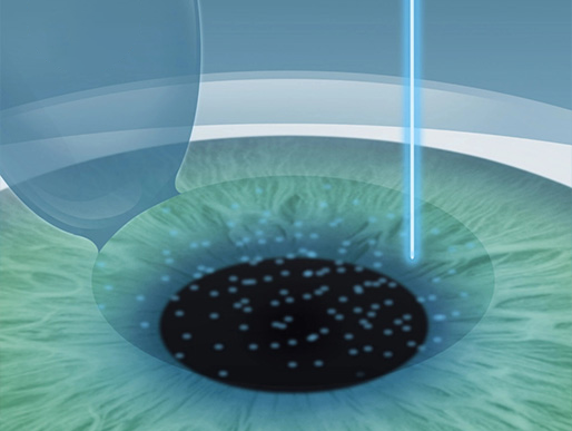 Schritt 2: LASIK Augenlasern für ein Leben ohne Brille im Augenzentrum Oberstenfeld