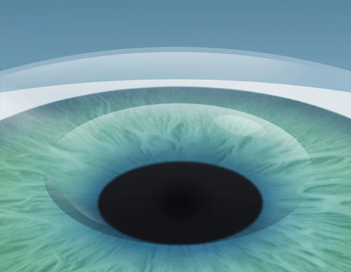 Schritt 3: LASIK Augenlasern für ein Leben ohne Brille im Augenzentrum Oberstenfeld